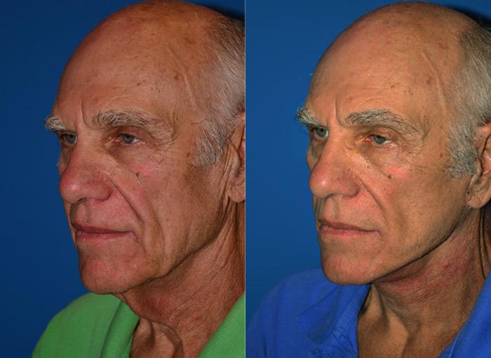 Before and after pictures - Clevens Face and Body Specialists